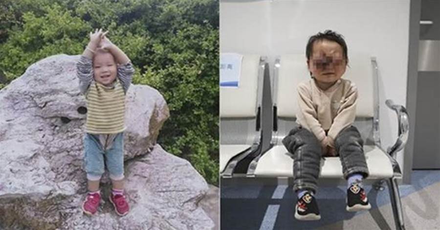 可憐天下父母心！2歲男孩雙眼被腫瘤撐「爆」，父母背娃跨2500公里緊急求救，請大家加油集氣
