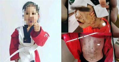 鼻樑骨折、嘴唇鉸爛、顱內出血......黑龍江4歲女童遭繼母虐待送ICU 父親回應：我沒參與毆打，不知情