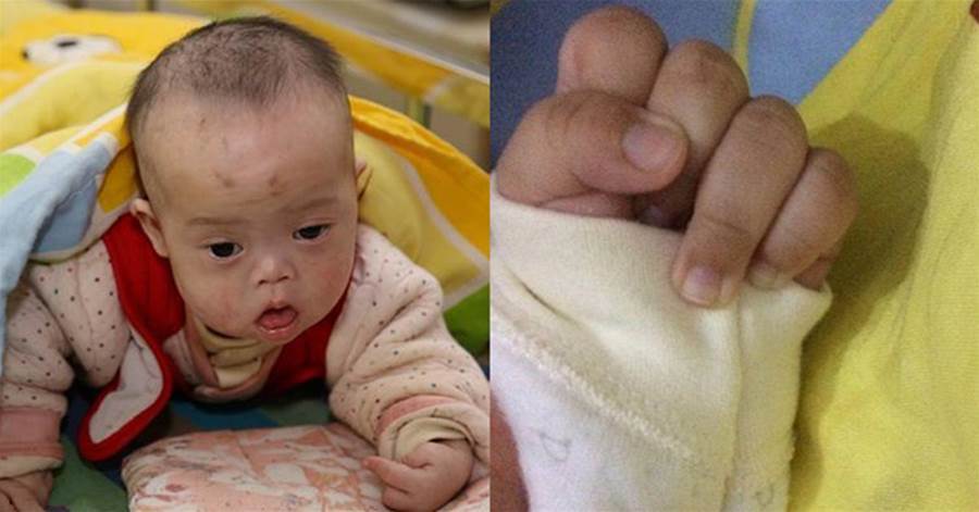 6個月寶寶握緊拳頭不放，奶奶發現不對送醫檢查，醫生：沒救了
